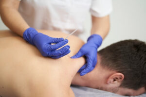 Clinician performing dry needling on a patient's neck and shoulder area.
