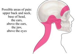 Resolving Headaches at the Back of the Head