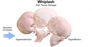 Whiplash Mechanism of Injury